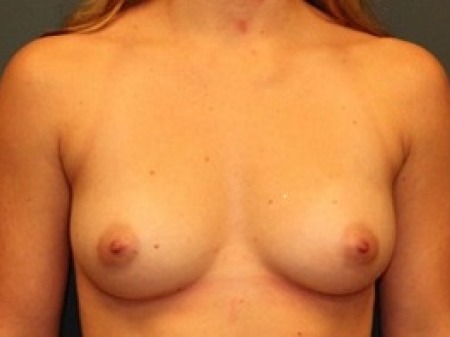 Breast Augmentation Before & After Patient #247