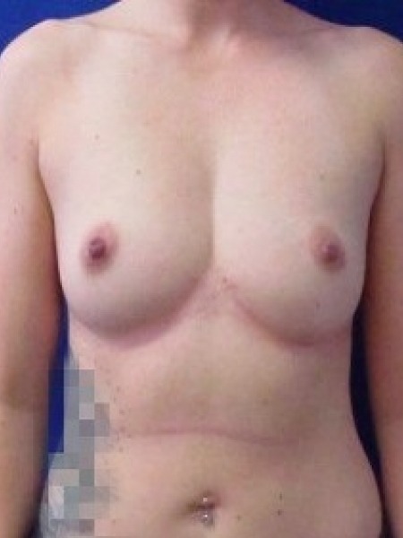 Breast Augmentation Before & After Patient #278