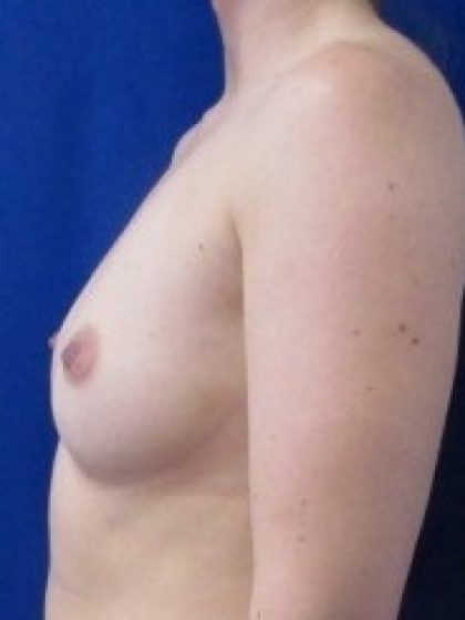Breast Augmentation Before & After Patient #278