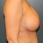 Breast Augmentation Before & After Patient #271