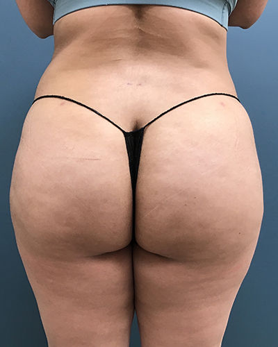 Patient #1055 Brazilian Butt Lift Before and After Photos