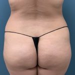 Brazilian Butt Lift Before & After Patient #1055