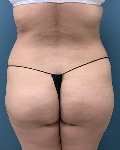Brazilian Butt Lift Before & After Patient #1055