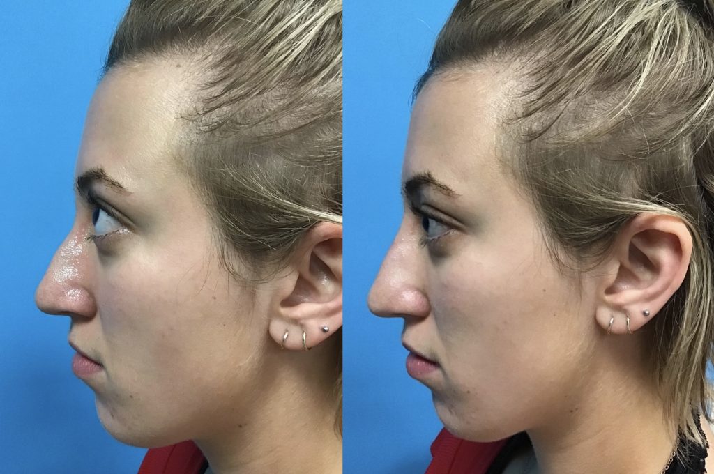 liquid rhinoplasty las vegas