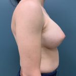 Breast Augmentation Before & After Patient #217