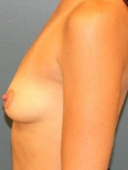 Breast Augmentation Before & After Patient #233