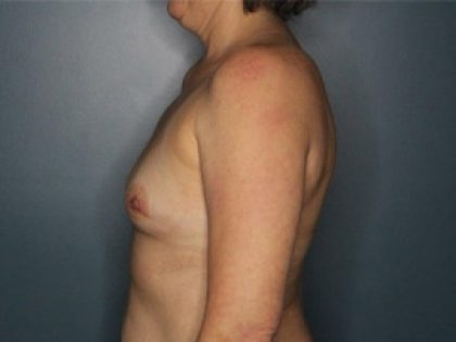 Breast Reconstruction Before & After Patient #257