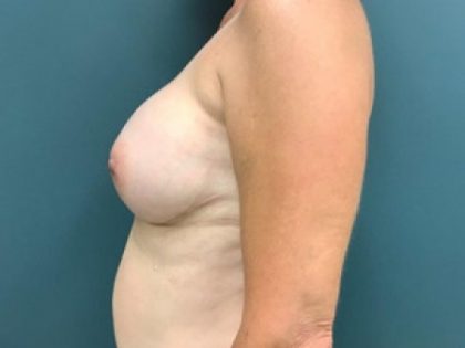 Breast Reconstruction Before & After Patient #257
