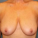 Breast Lift Before & After Patient #314