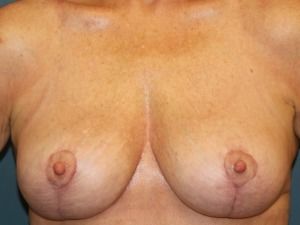 Breast Lift Before & After Patient #314