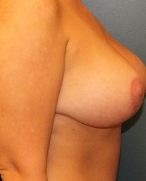 Breast Lift Before & After Patient #321