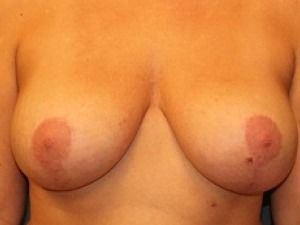 Breast Lift Before & After Patient #321
