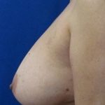 Breast Lift Before & After Patient #328