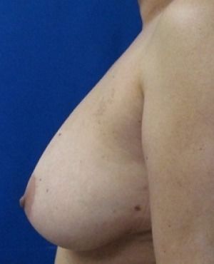 Breast Lift Before & After Patient #328