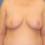 Breast Reduction Before & After Patient #335