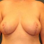 Breast Reduction Before & After Patient #356