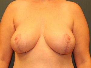 Breast Reduction Before & After Patient #356