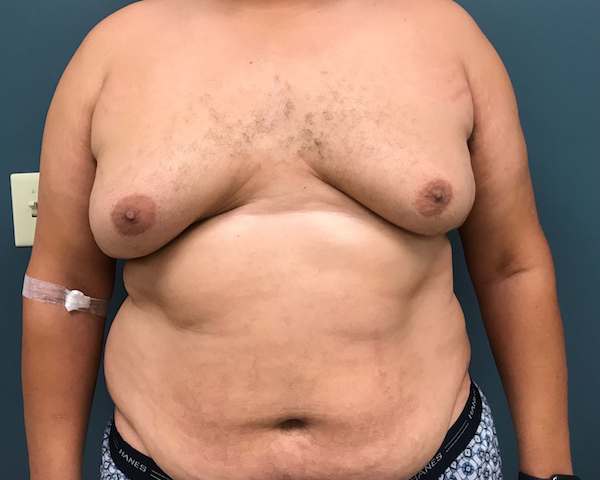 Daddy Do-Over Before & After Patient #210