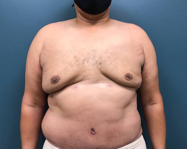 Daddy Do-Over Before & After Patient #210
