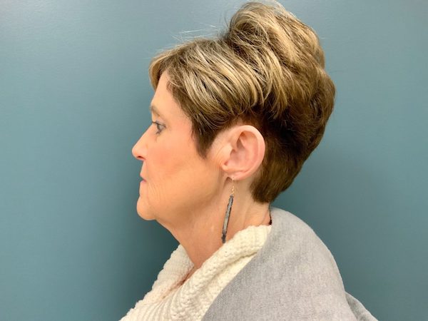 Facelift Before & After Patient #497