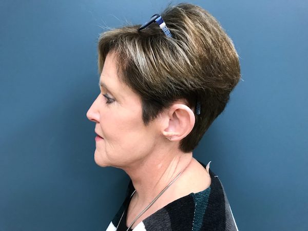 Facelift Before & After Patient #497
