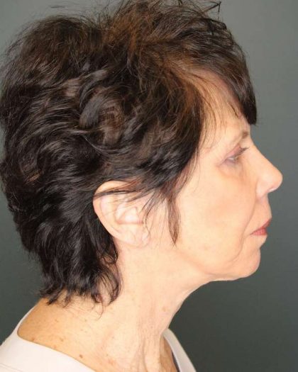Facelift Before & After Patient #504