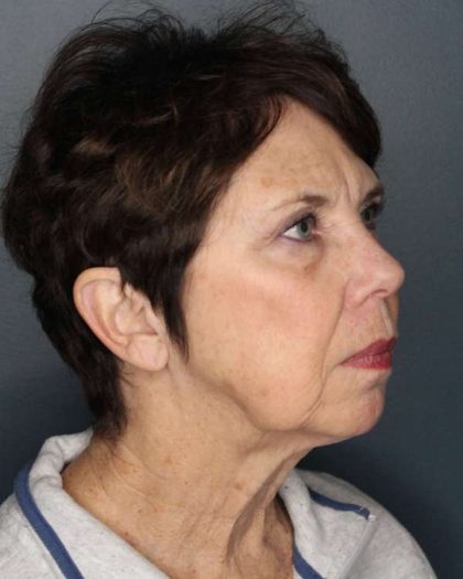Facelift Before & After Patient #504