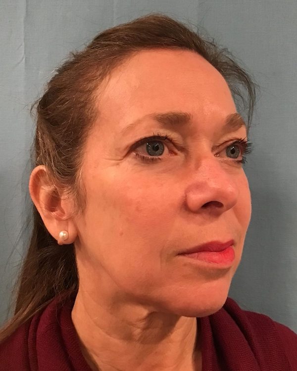 Facelift Before & After Patient #511