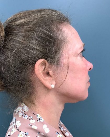 Facelift Before & After Patient #511
