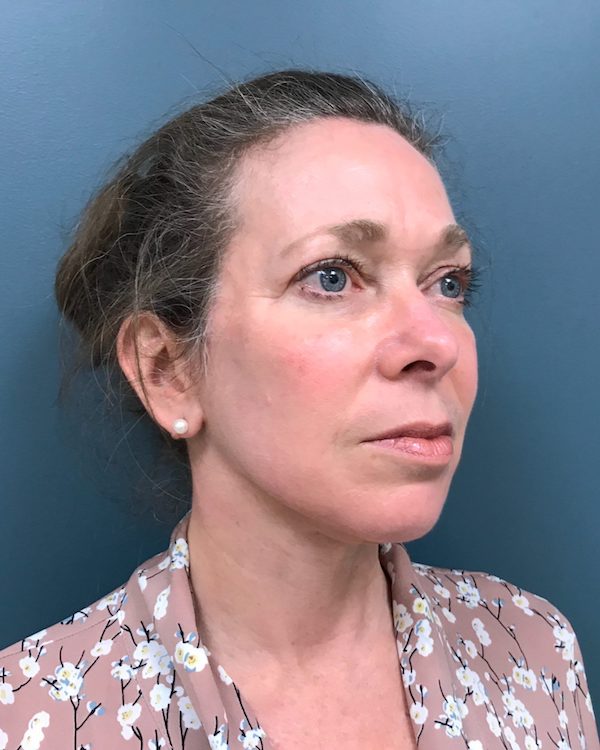 Facelift Before & After Patient #511