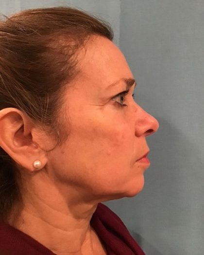 Facelift Before & After Patient #511