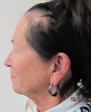Facelift Before & After Patient #522