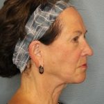 Facelift Before & After Patient #522