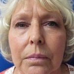 Facelift Before & After Patient #529