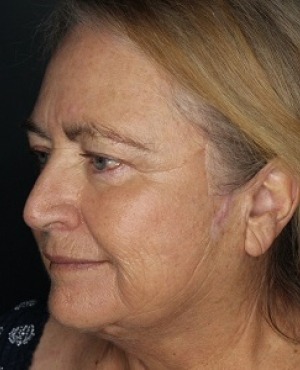 Facelift Before & After Patient #532