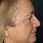 Facelift Before & After Patient #532