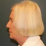 Facelift Before & After Patient #539
