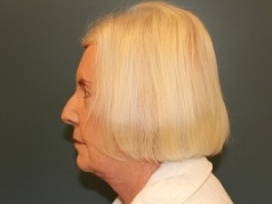 Facelift Before & After Patient #539