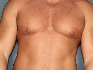 Gynecomastia Before & After Patient #409