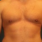 Gynecomastia Before & After Patient #409