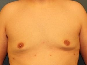 Gynecomastia Before & After Patient #416