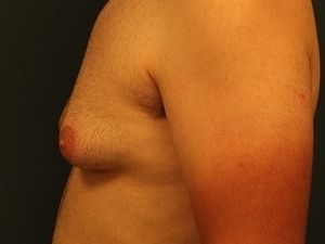 Gynecomastia Before & After Patient #416