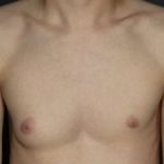 Gynecomastia Before & After Patient #423