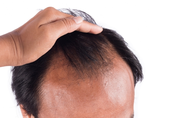 ACP For Hair Loss