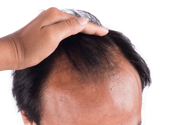 Prp For Hair Loss Lexington