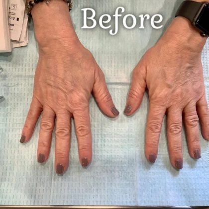 Hand Rejuvenation Before & After Patient #491