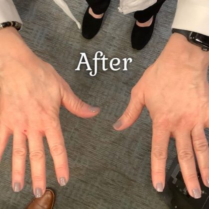 Hand Rejuvenation Before & After Patient #491