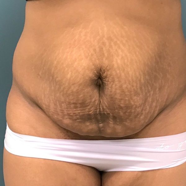 Liposuction Before & After Patient #430