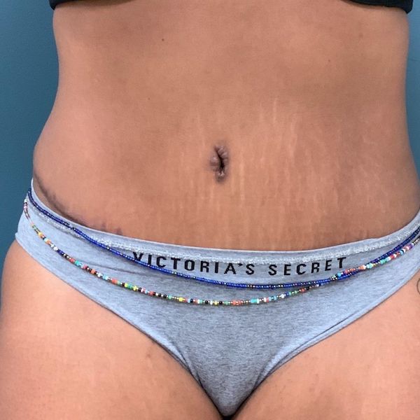 Liposuction Before & After Patient #430