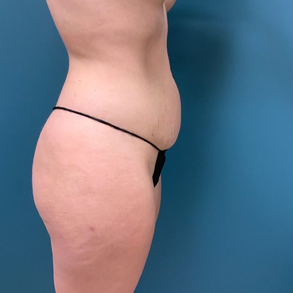 Mommy Makeover Before & After Patient #484